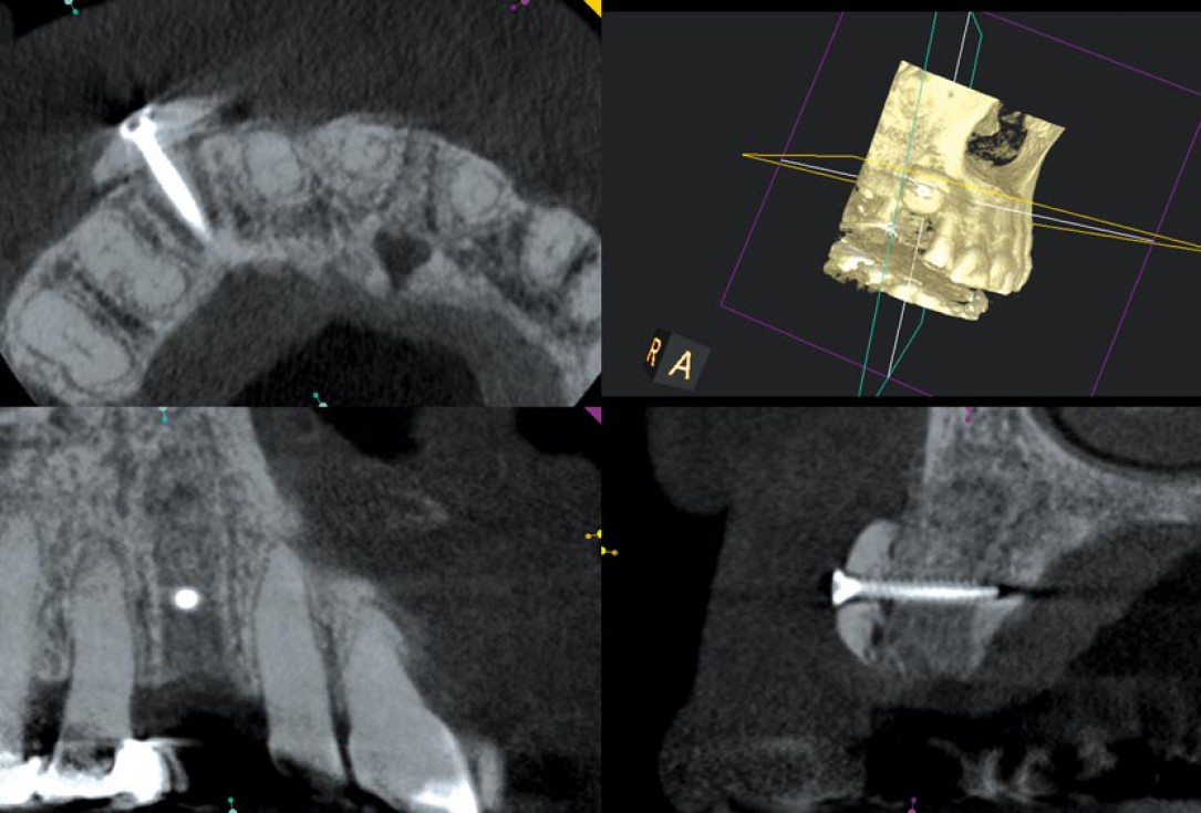 Block augmentation with maxgraft® in the maxilla - PD Dr. Dr. F. Kloss