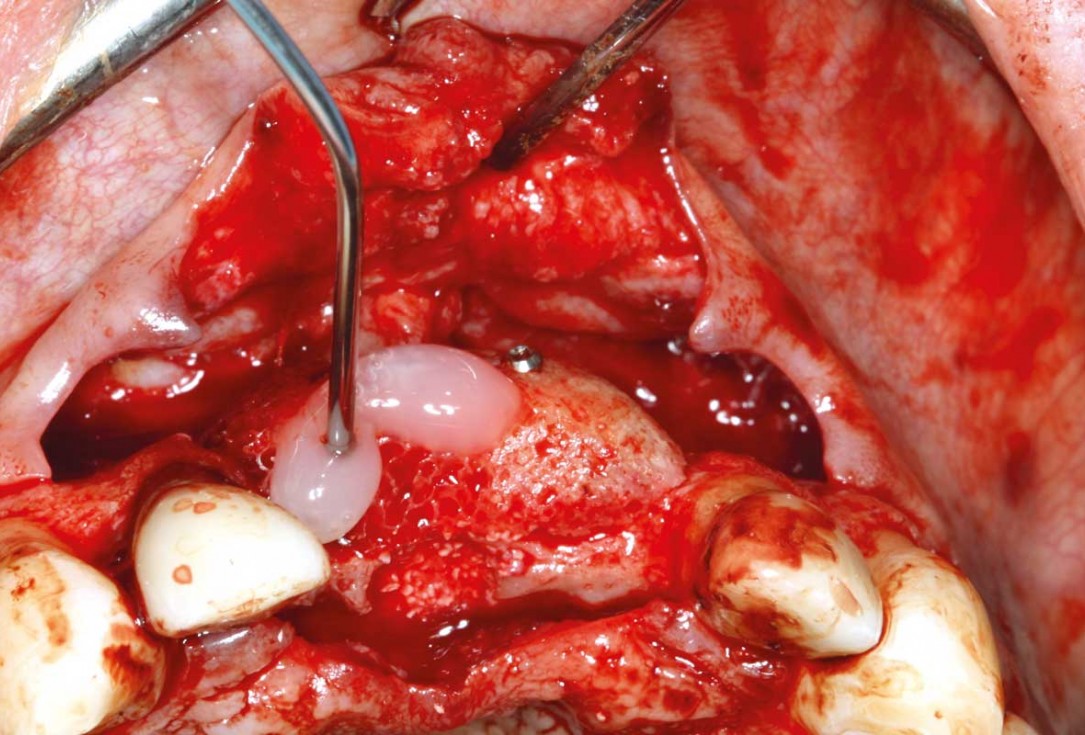 Ridge augmentation in the maxilla with maxgraft® bonebuilder in the aesthetic zone - Dr. M. Kristensen