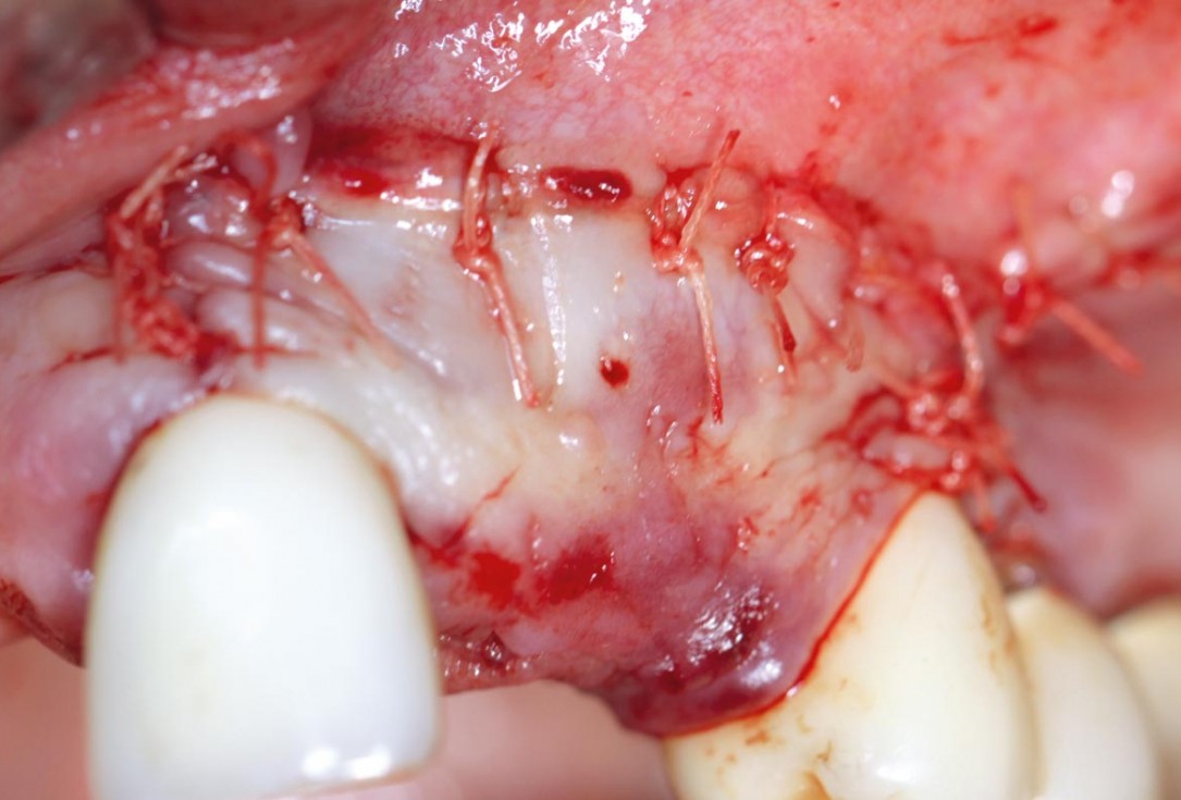 botiss maxgraft® bonebuilder for atrophic maxilla reconstruction - Clinical case