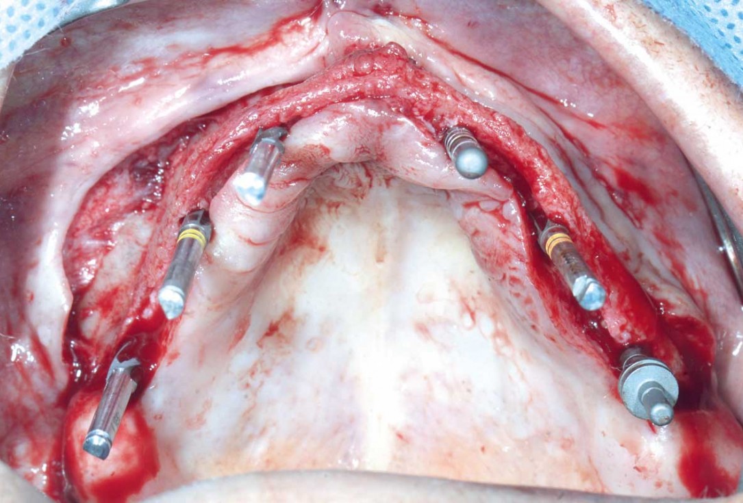 Full arch GBR using botiss cerabone®, maxgraft® and Jason® membrane with simultaneous implantation of 6 Straumann® implants - Dres. A. Signorio and G. Molina