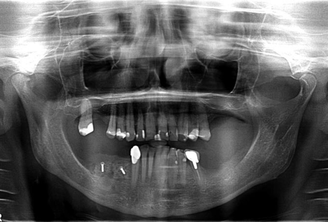 Block augmentation with maxgraft® in the mandible - PD Dr. Dr. F. Kloss