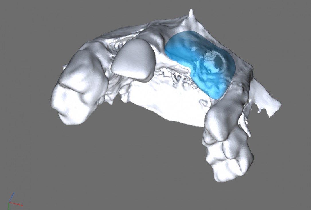 botiss maxgraft® bonebuilder for aesthetic zone reconstruction - Clinical case