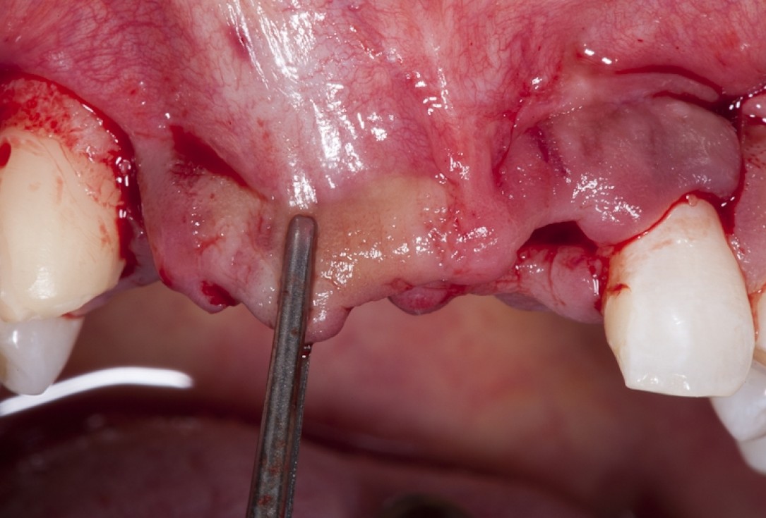 Block augmentation with maxgraft® block and mucoderm® - Dr. K. Chmielewski