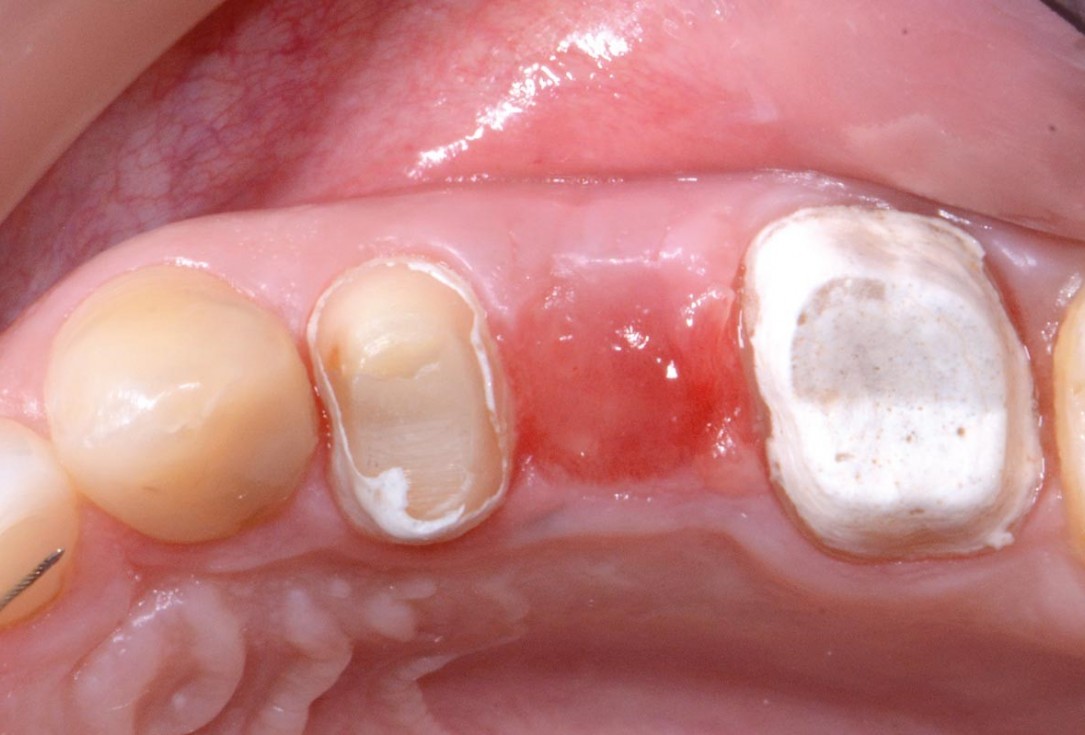 Full bone regeneration in extraction socket augmented with maxgraft® and Jason® membrane – Dr. C. Landsberg