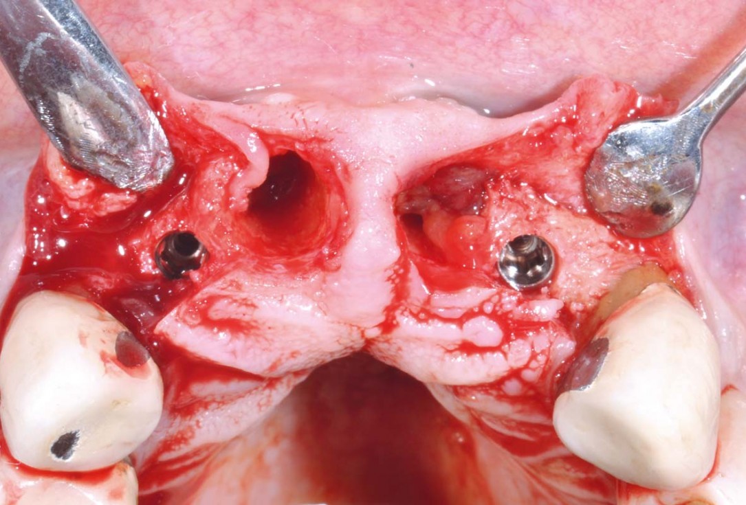 Hard and soft tissue management in immediate restoration