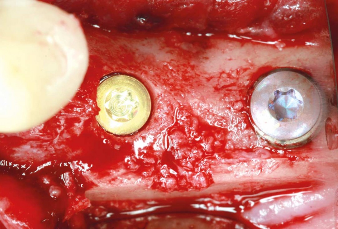 maxgraft® cortico at free-end situation in the mandible - J. Kielhorn