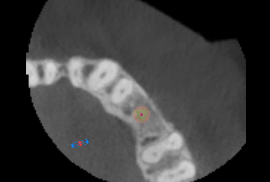 Reconstruction of a single tooth defect with the shell technique - Dr. Andoni Jones
