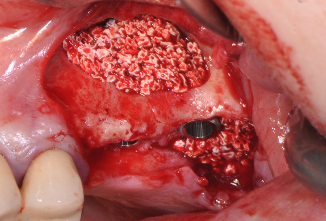 Sinus lift with simultaneous implantation with cerabone® and collprotect® membrane - clinical case Dr. Victor Kalenchuk