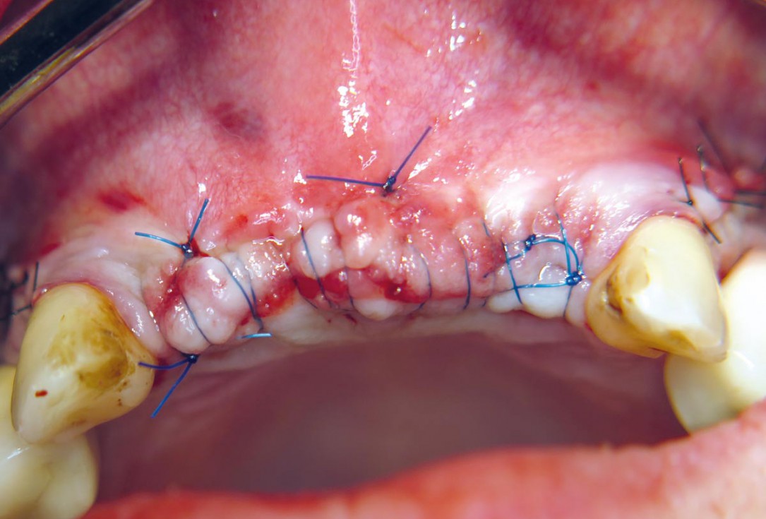 Three-dimensional augmentation with maxgraft® cortico - M.Sc. E. Kapogianni