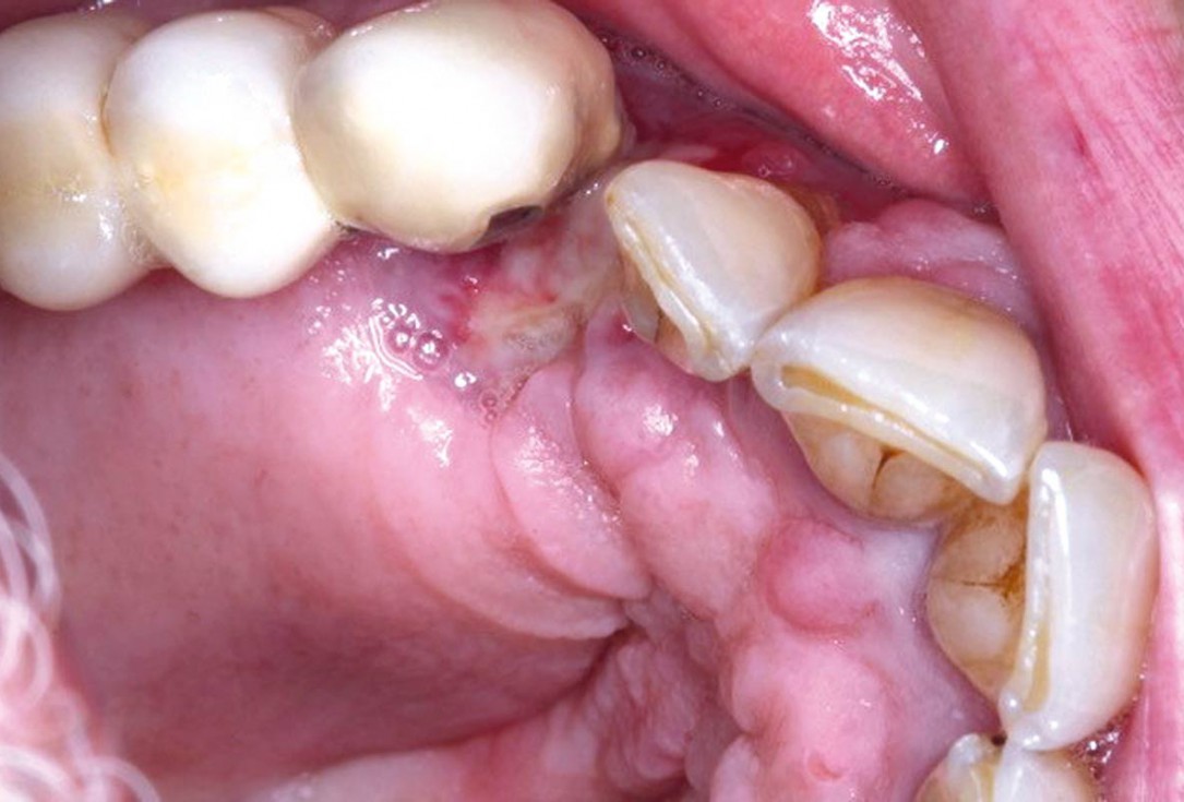 Regeneration with mucoderm® after fibroma resection