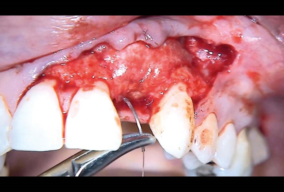 Simultaneous GBR and implantation using maxgraft® granules and autologous bone
