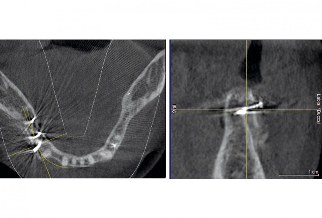 Horizontal ridge augmentation with maxgraft® cortico - M.Sc. E. Kapogianni