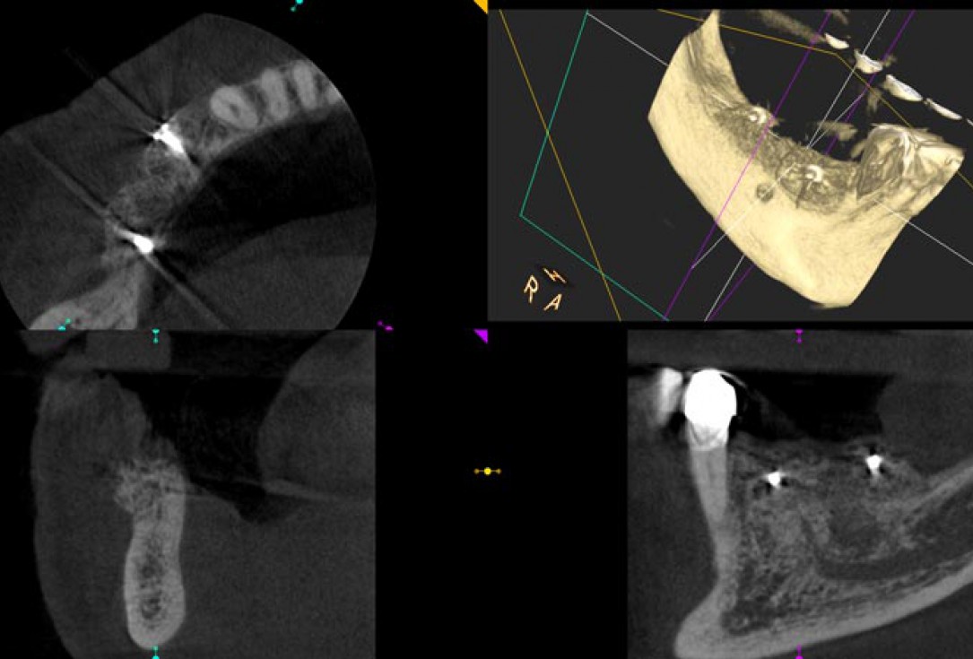 Block augmentation with maxgraft® in the mandible - PD Dr. Dr. F. Kloss