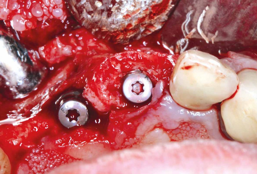 GBR and soft tissue augmentation with cerabone® and mucoderm® - H. Maghaireh & V. Ivancheva