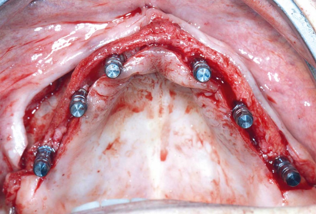 Full arch GBR using botiss cerabone®, maxgraft® and Jason® membrane with simultaneous implantation of 6 Straumann® implants - Dres. A. Signorio and G. Molina
