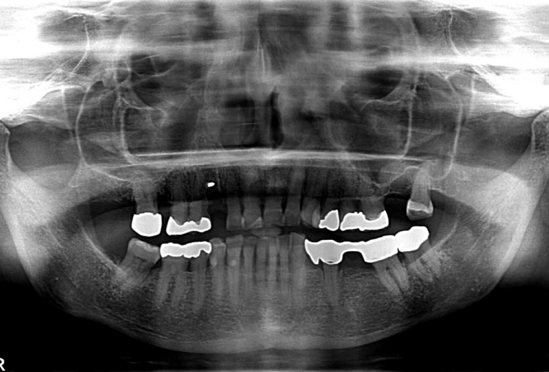 Block augmentation with maxgraft® in the maxilla - PD Dr. Dr. F. Kloss