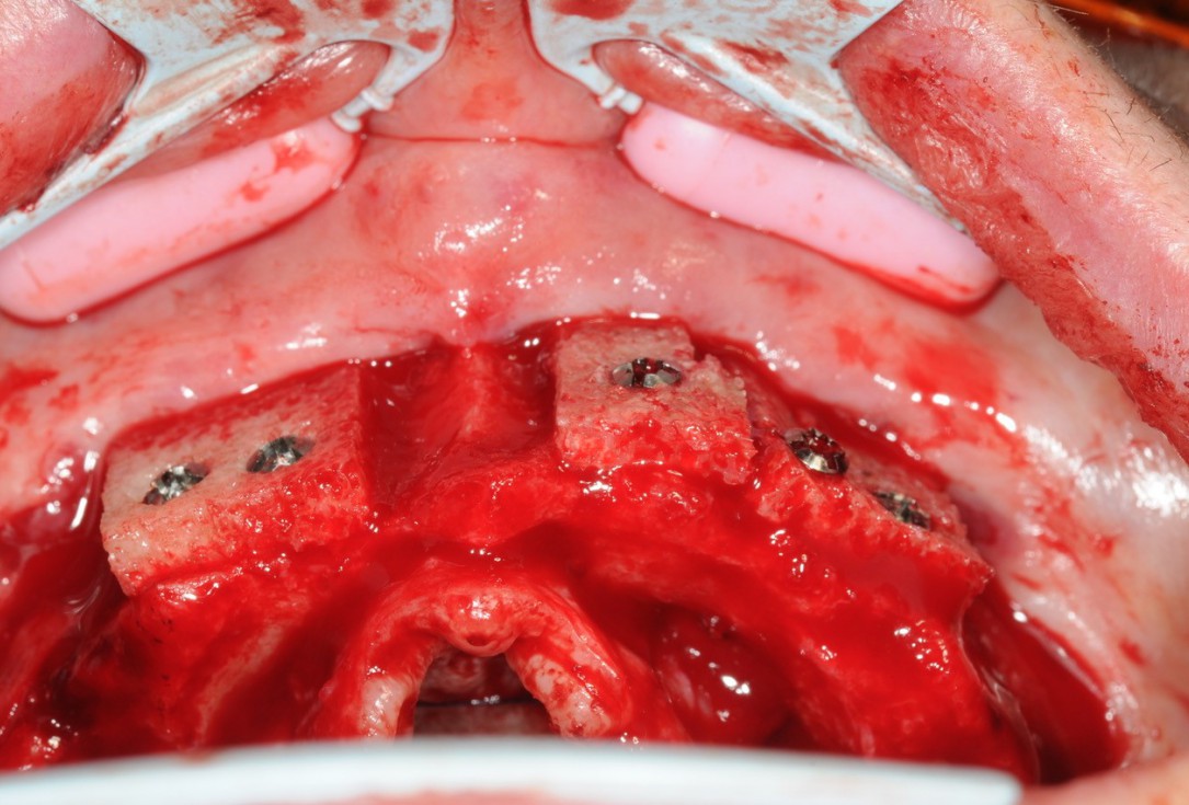 Reconstruction of maxillary ridge with maxgraft® block - Amit Patel