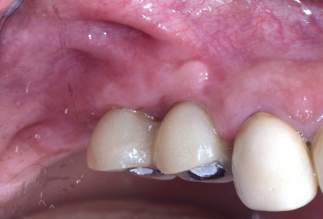 GBR with Jason membrane® and cerabone® - D. Fontana