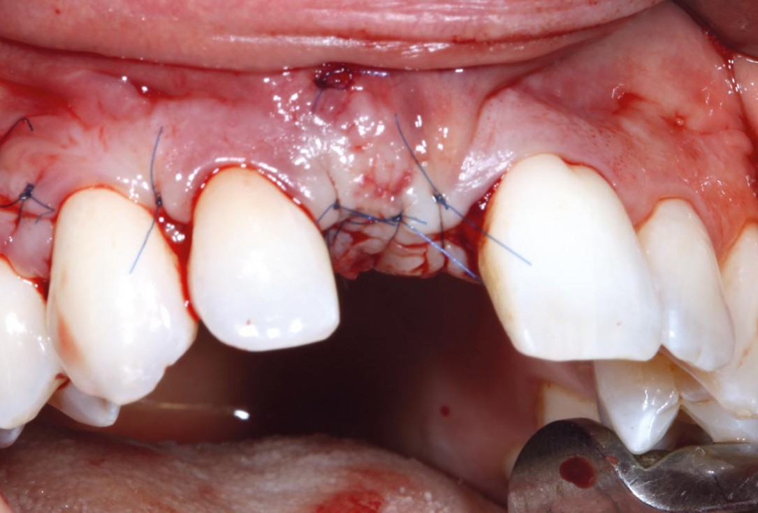 10/11 maxgraft® cortico at combined defect palatally and facially - Dr. K. Höckl