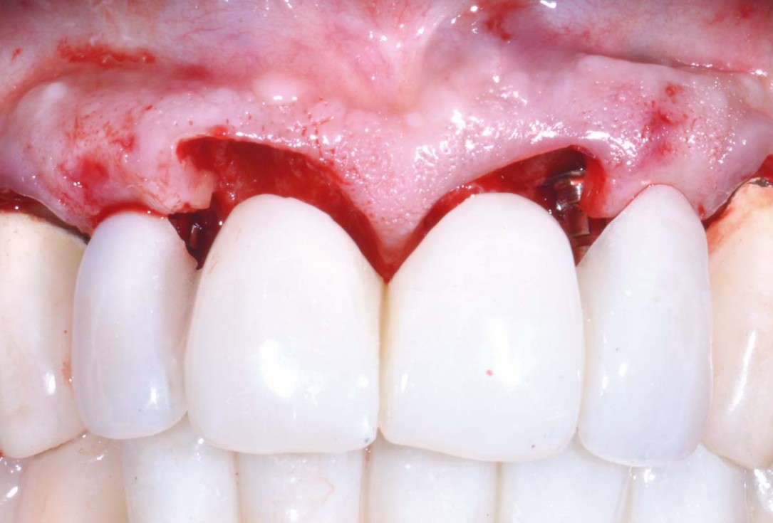Hard and soft tissue management in immediate restoration