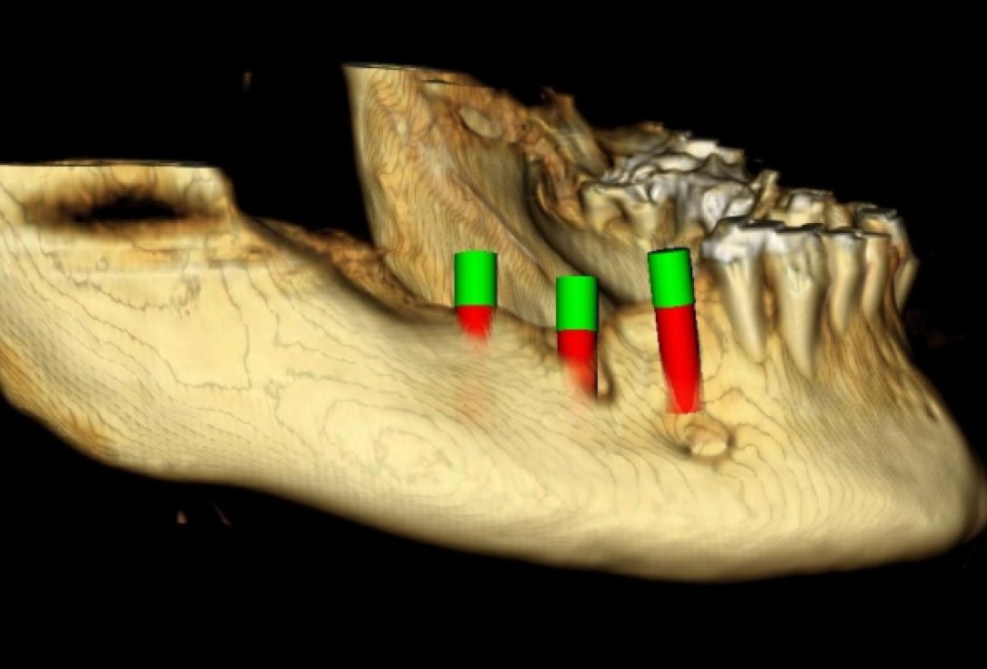 Ridge augmentation with maxgraft® bonebuilder - Dr. M. Jacotti