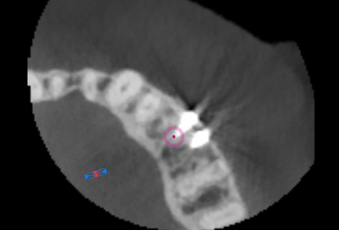 Reconstruction of a single tooth defect with the shell technique - Dr. Andoni Jones