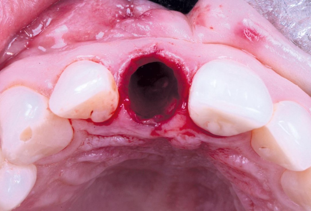 Excellent aesthetic result of buccal augmentation with mucoderm® and maxgraft® after immediate implant placement - 3-years follow-up - Dr. A. Puišys 
