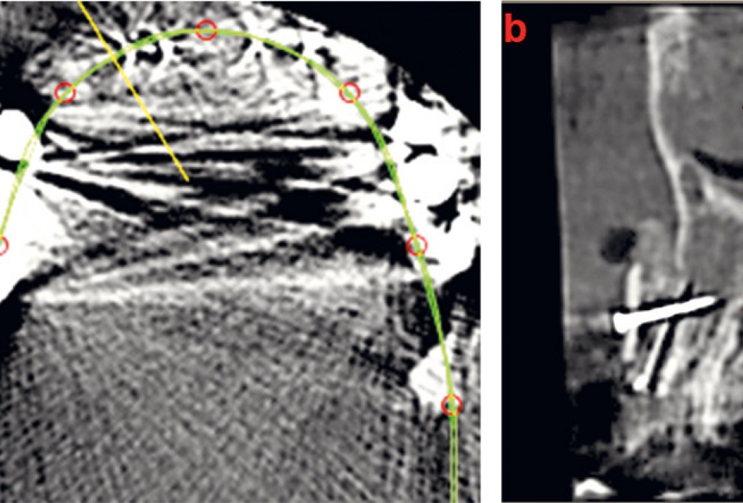 Three-dimensional augmentation with maxgraft® cortico - M.Sc. E. Kapogianni