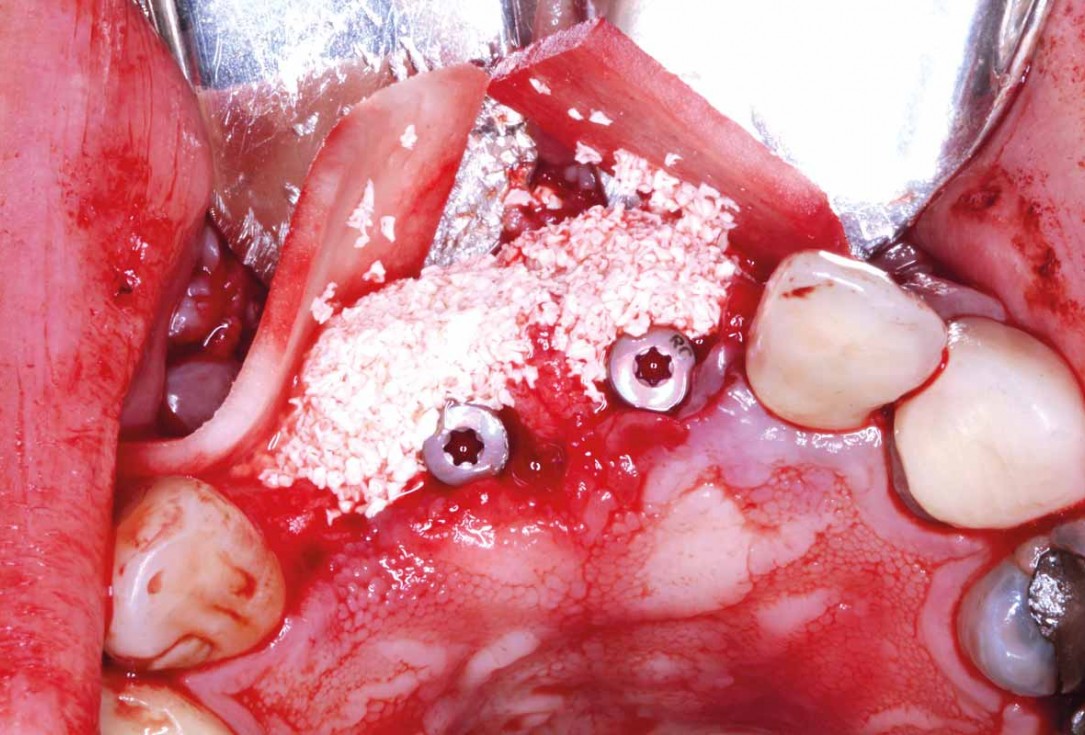 GBR and soft tissue augmentation with cerabone® and mucoderm® - H. Maghaireh & V. Ivancheva