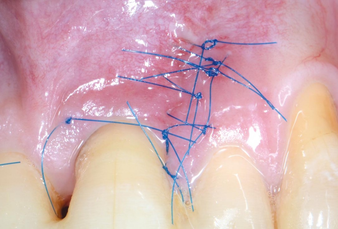 EPP for the treatment of a deep intrabony defect 