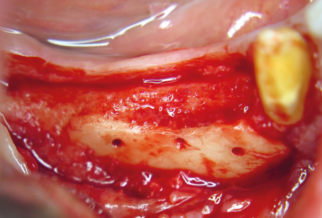 Horizontal ridge augmentation with maxgraft® cortico - M.Sc. E. Kapogianni