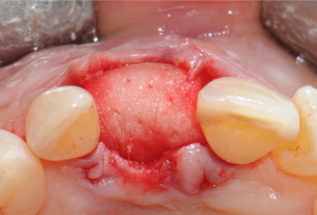 10/18 Tooth extraction and socket sealing with mucoderm® - Dr. A. Rossi