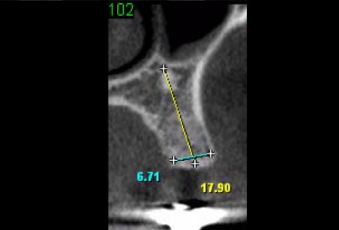 Full bone regeneration in extraction socket augmented with maxgraft® and Jason® membrane – Dr. C. Landsberg