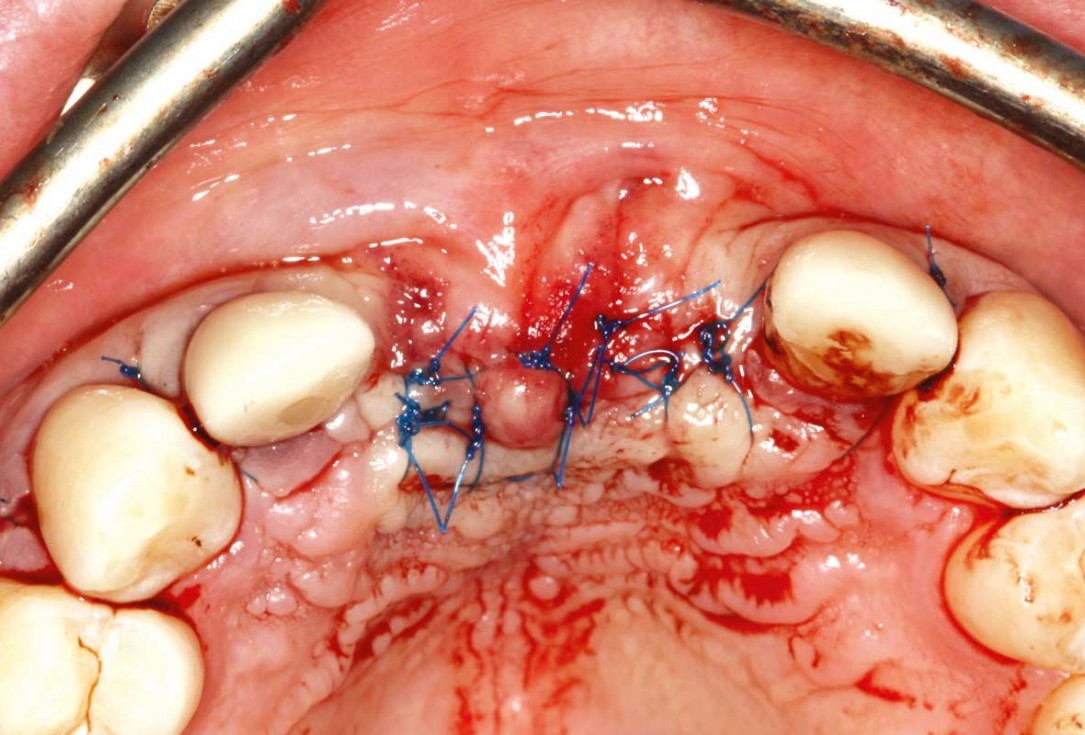 Ridge augmentation in the maxilla with maxgraft® bonebuilder in the aesthetic zone - Dr. M. Kristensen