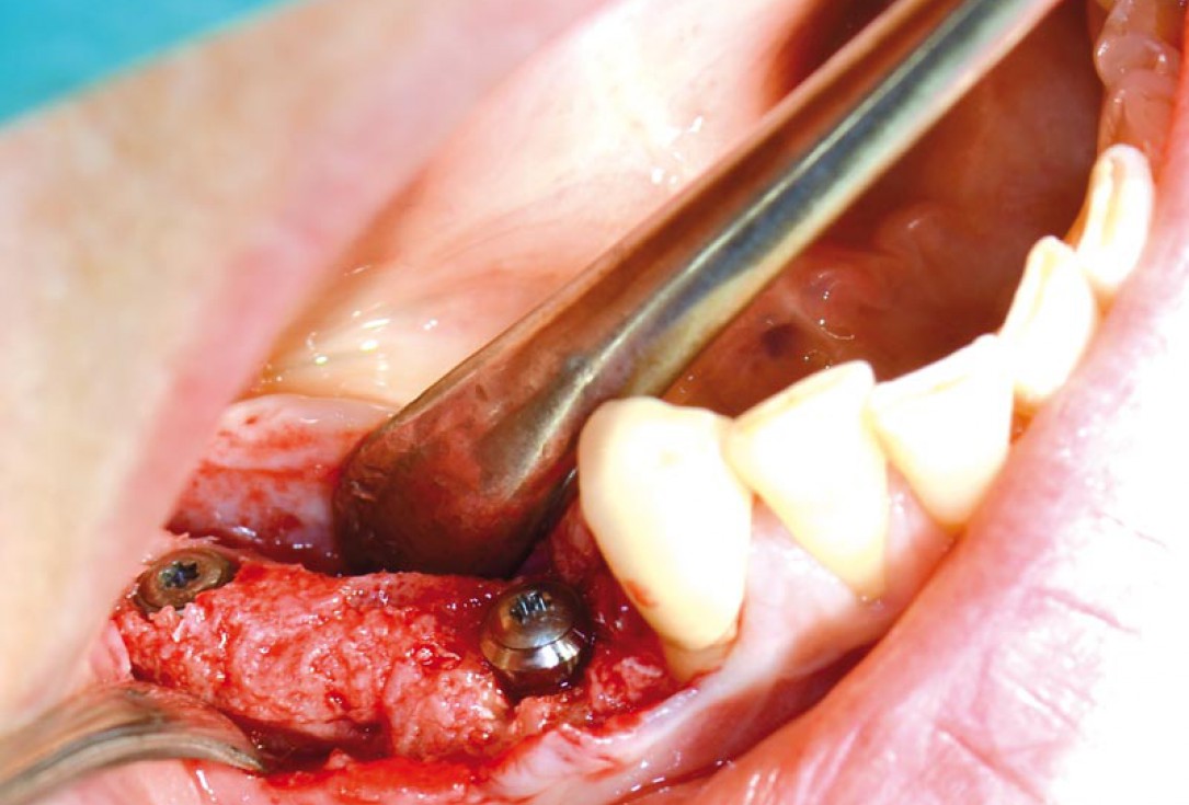 Block augmentation with maxgraft® in the mandible - PD Dr. Dr. F. Kloss