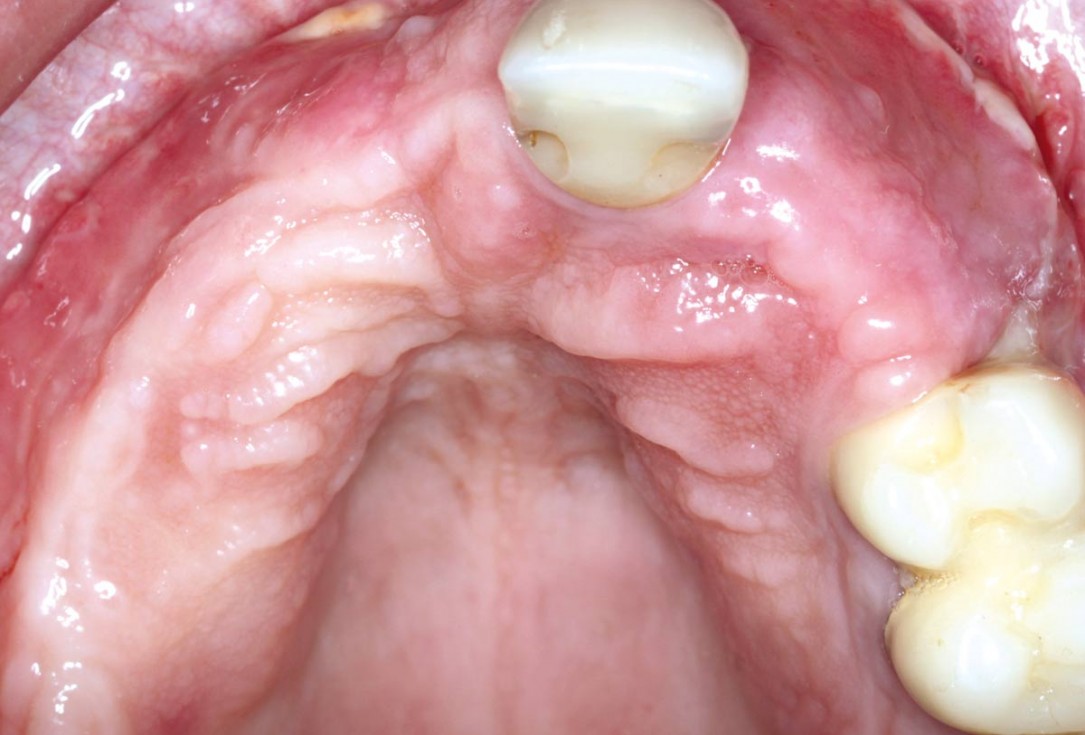 botiss maxgraft® bonebuilder for atrophic maxilla reconstruction - Clinical case