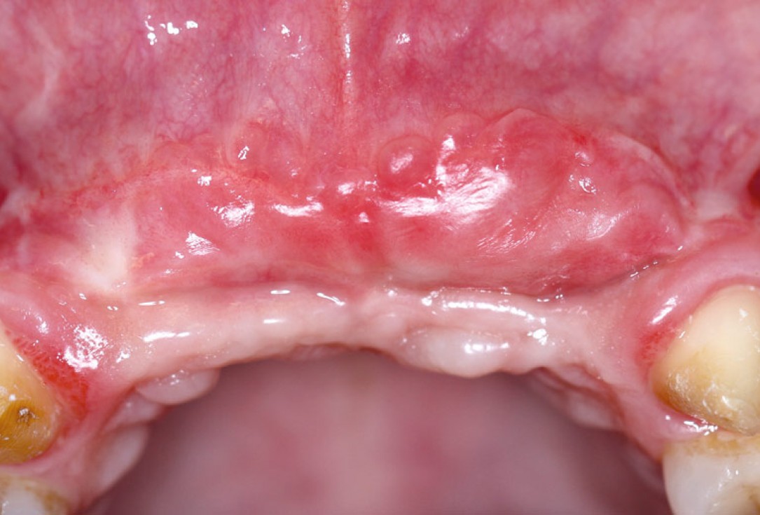 botiss maxgraft® bonebuilder aesthetic reconstruction - Clinical case