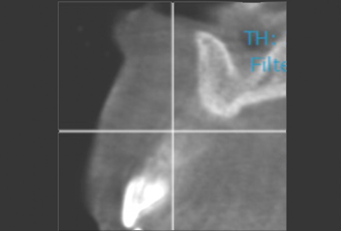 2/11 maxgraft® cortico at combined defect palatally and facially - Dr. K. Höckl