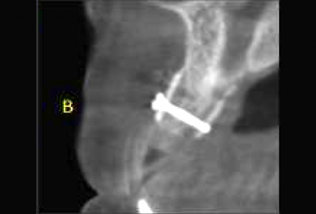 11/11 maxgraft® cortico at combined defect palatally and facially - Dr. K. Höckl