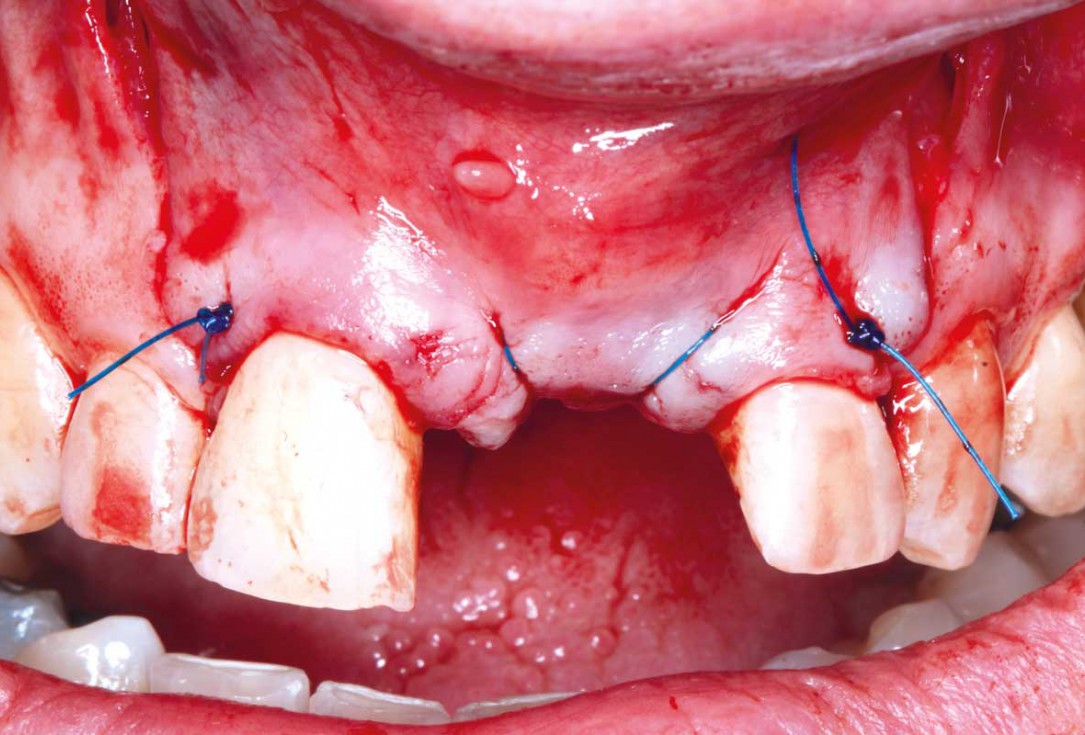 Block grafting in the aesthetic zone with maxgraft®, Jason® membrane and cerabone® - Dres. H. Maghaireh and V. Ivancheva