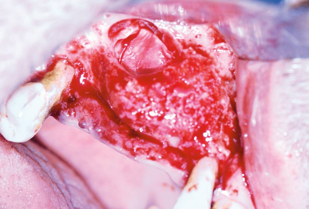 Ridge augmentation with maxgraft® bonebuilder and sinus floor elevation – Dr. K.P. Schiechl