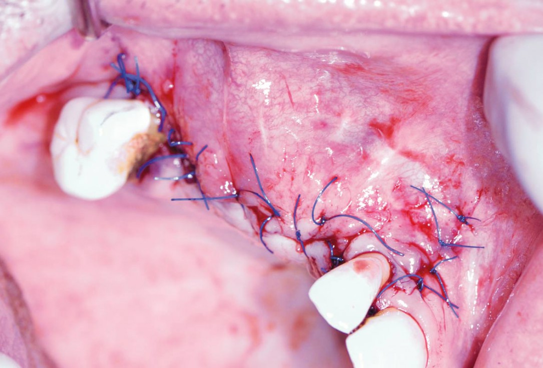 Ridge augmentation with maxgraft® bonebuilder and sinus floor elevation – Dr. K.P. Schiechl