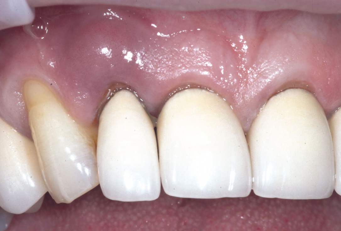 Bone augementation with maxresorb® - Dr. R. Cutts