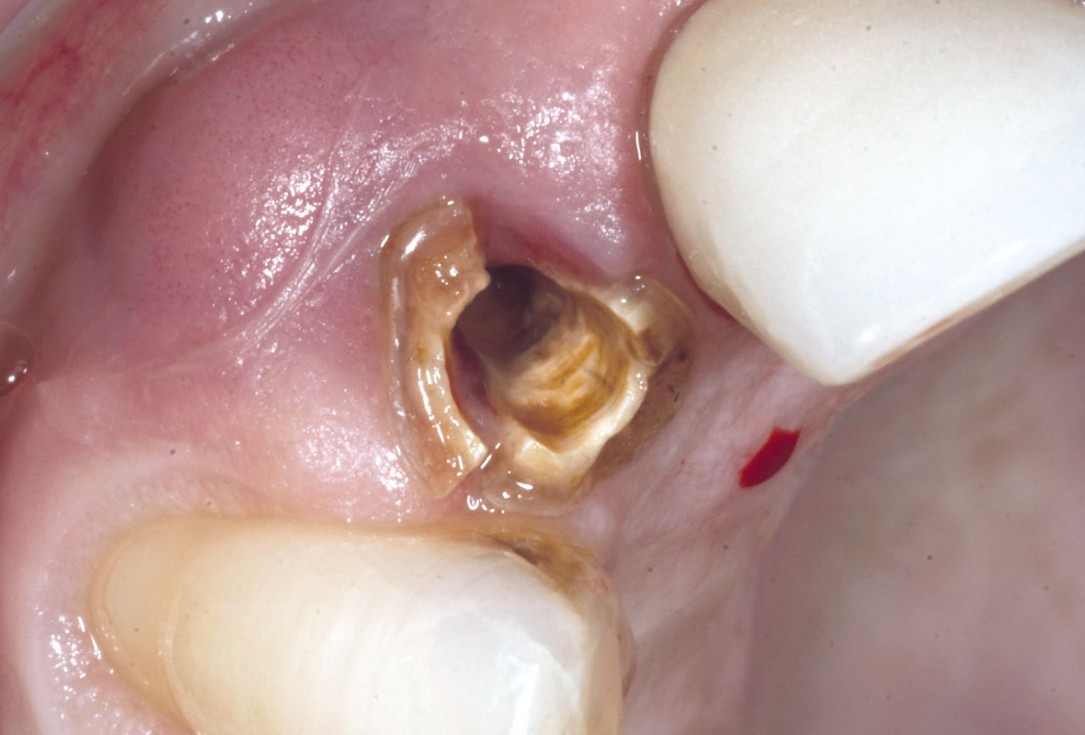 Bone augementation with maxresorb® - Dr. R. Cutts