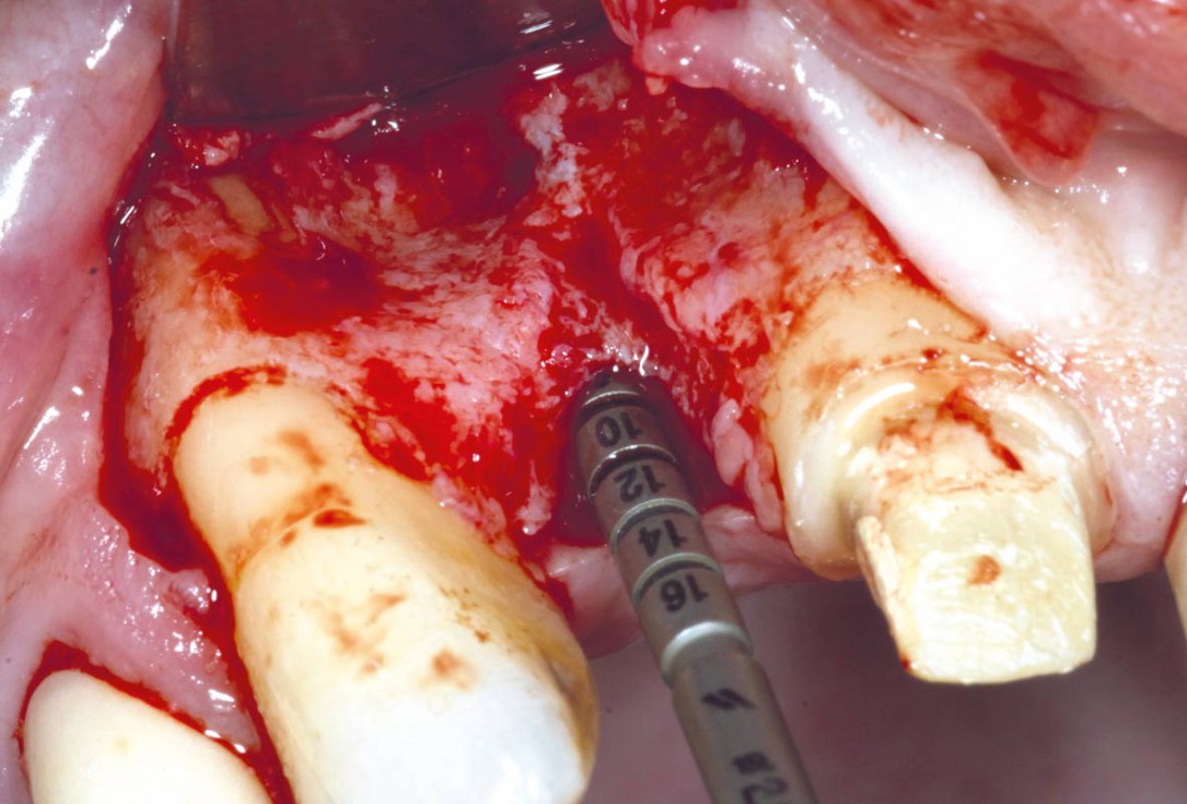 Bone augementation with maxresorb® - Dr. R. Cutts