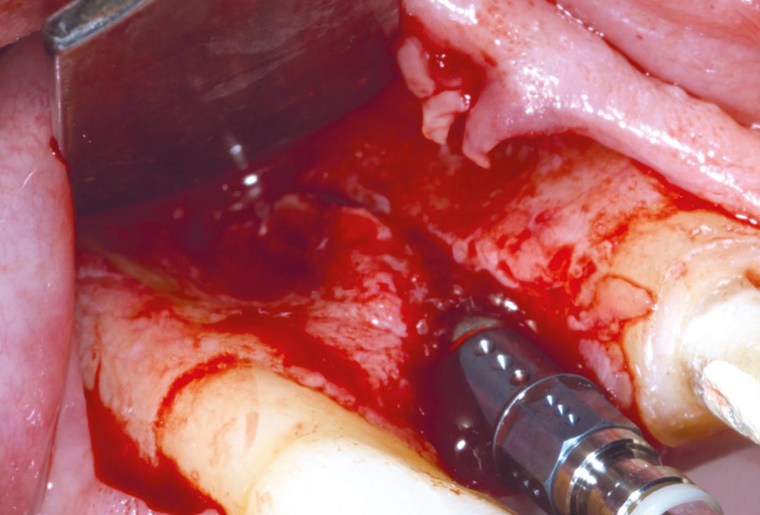 Bone augementation with maxresorb® - Dr. R. Cutts