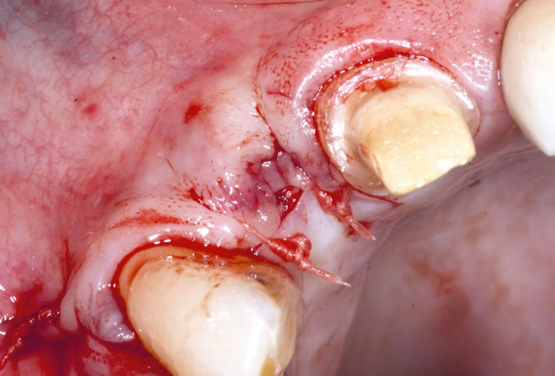 Bone augementation with maxresorb® - Dr. R. Cutts