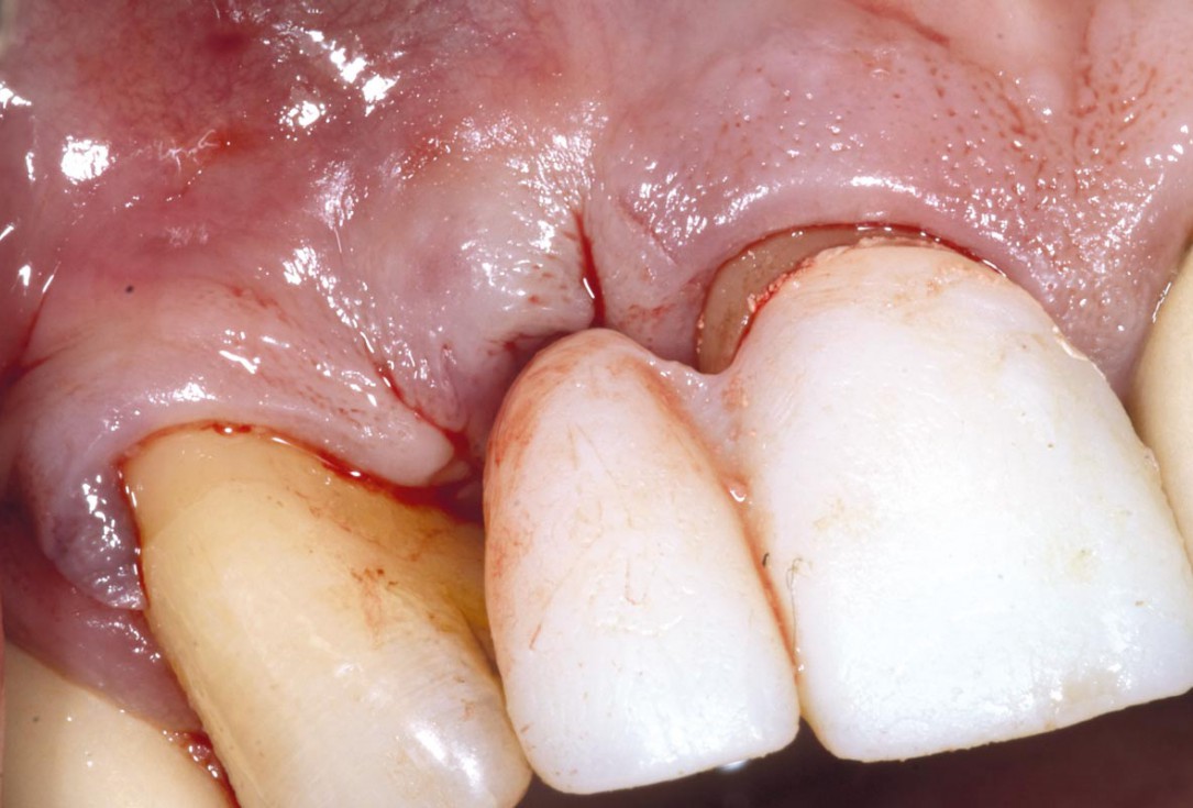 Bone augementation with maxresorb® - Dr. R. Cutts