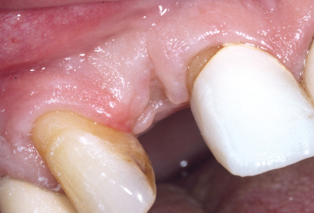 Bone augementation with maxresorb® - Dr. R. Cutts