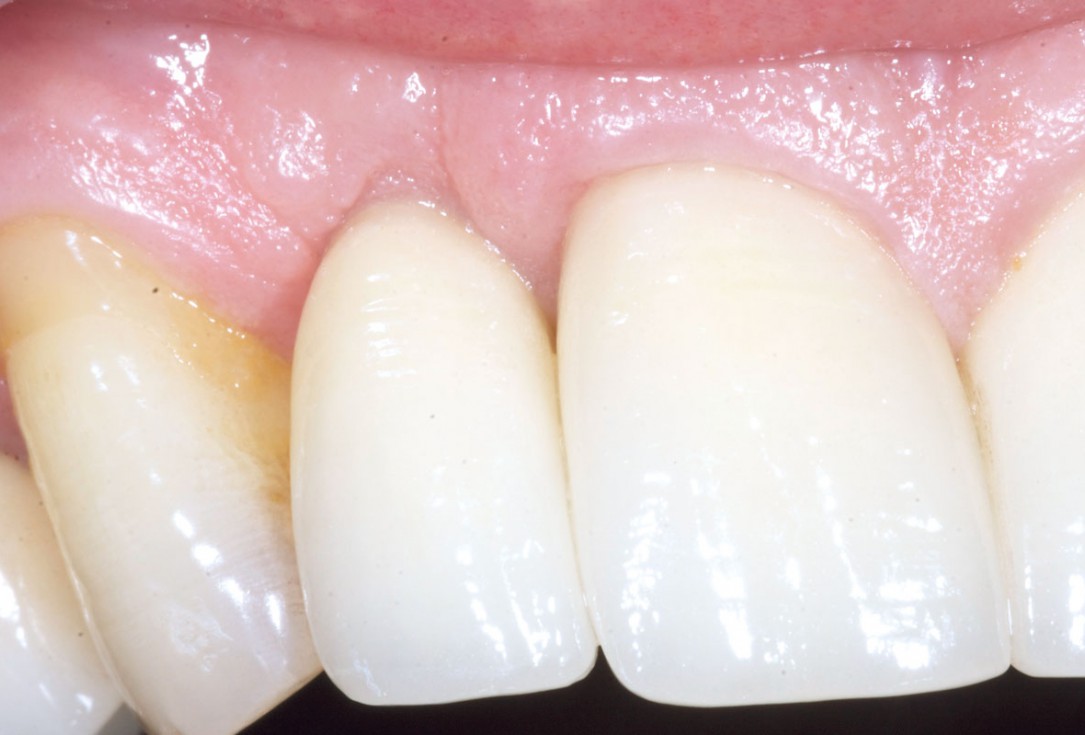 Bone augementation with maxresorb® - Dr. R. Cutts